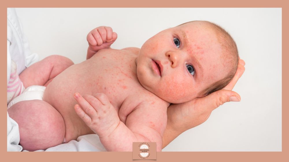 The Atopic March - image of a baby covered in eczema rash