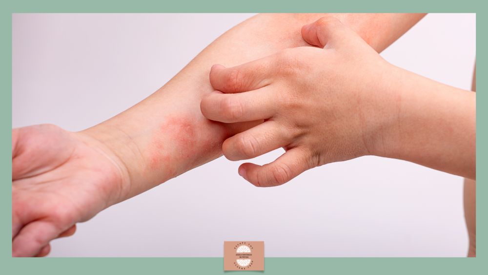Identifying the Children Who Wont Grow Out of Eczema - Escape The Eczema Trap