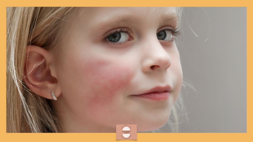 Identifying the Children Who Wont Grow Out of Eczema 3 - Escape The Eczema Trap