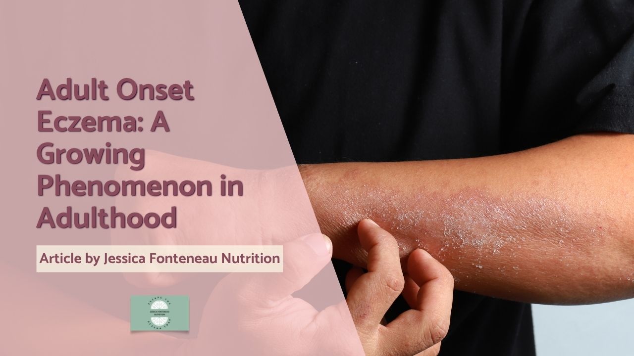 Adult Onset Eczema: A Growing Phenomenon in Adulthood