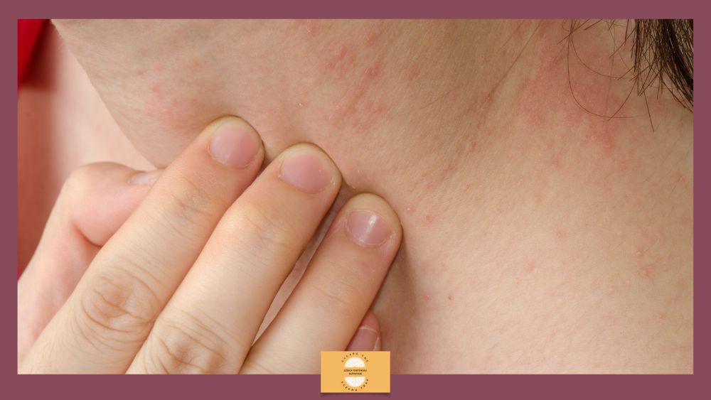 Adult Onset Eczema: A Growing Phenomenon in Adulthood - neck eczema
