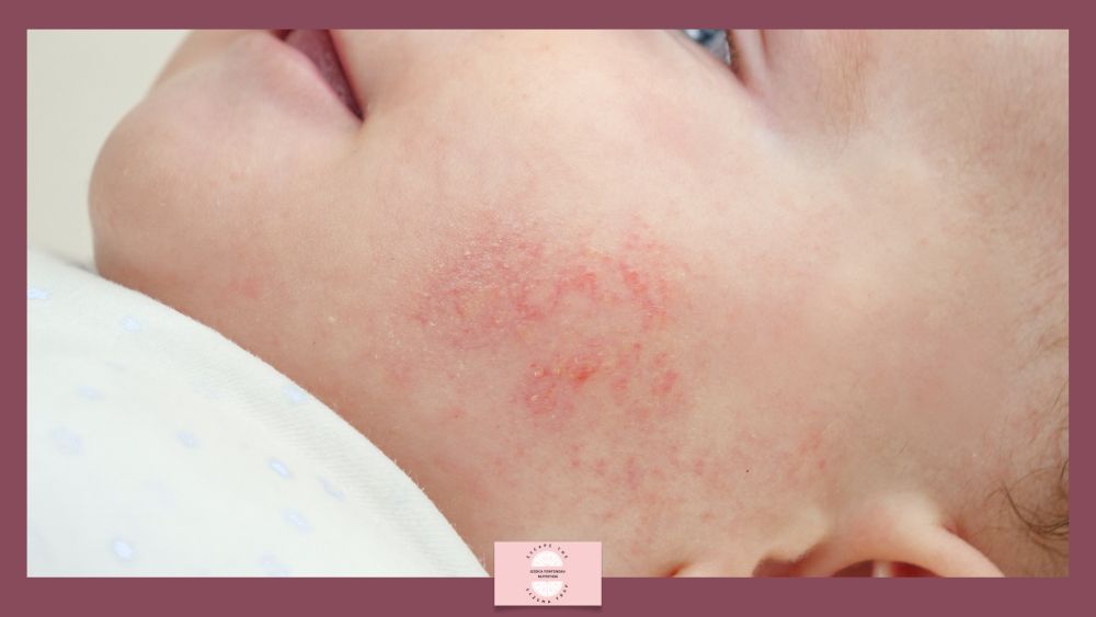 Close-up of a baby's cheek and neck with a red, irritated rash on the skin, small red patches scattered.