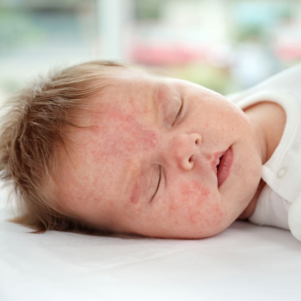 0-6 - Escape The Eczema Trap Little Eczema Trap - 0-6: baby with eczema on face.