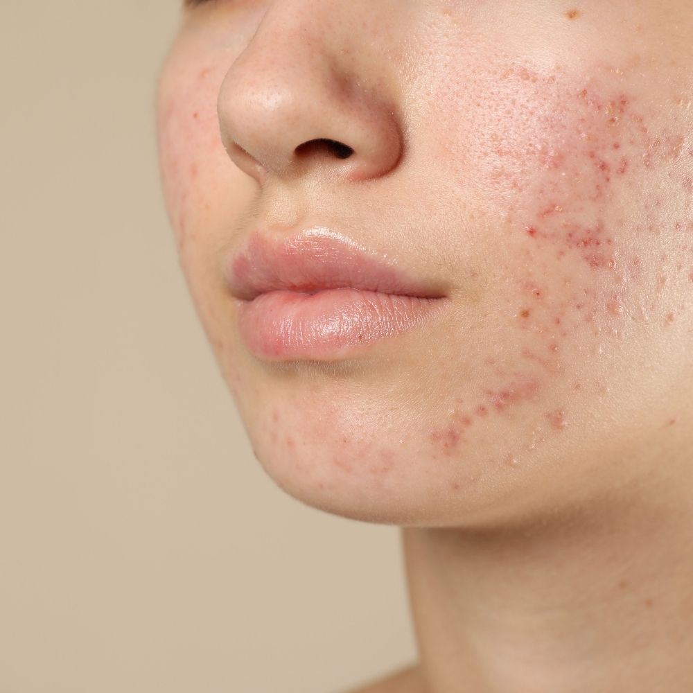 13-15 - Escape The Eczema Trap Little Eczema Trap - 13-15:Close-up of a girl's lower face showing red acne and blemishes on the cheek and jawline.