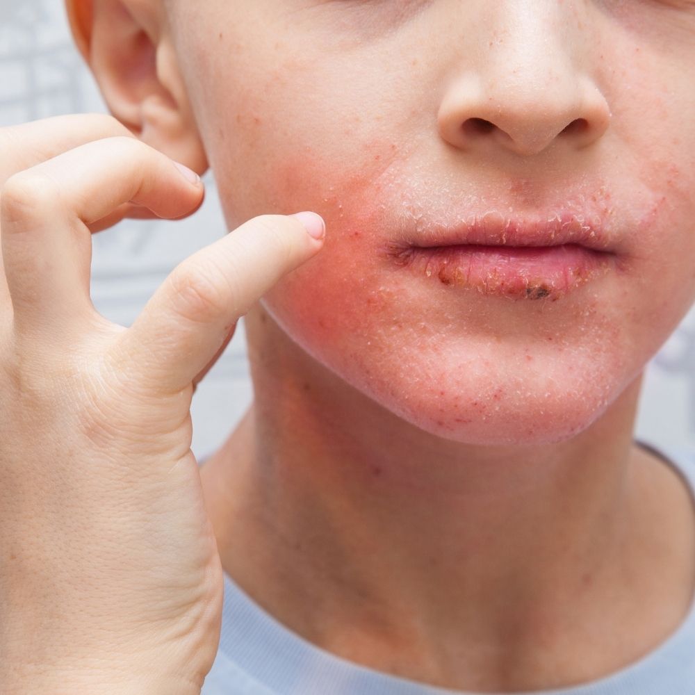 7-13 - Escape The Eczema Trap Little Eczema Trap - 7-13: older child with red, flaky skin.