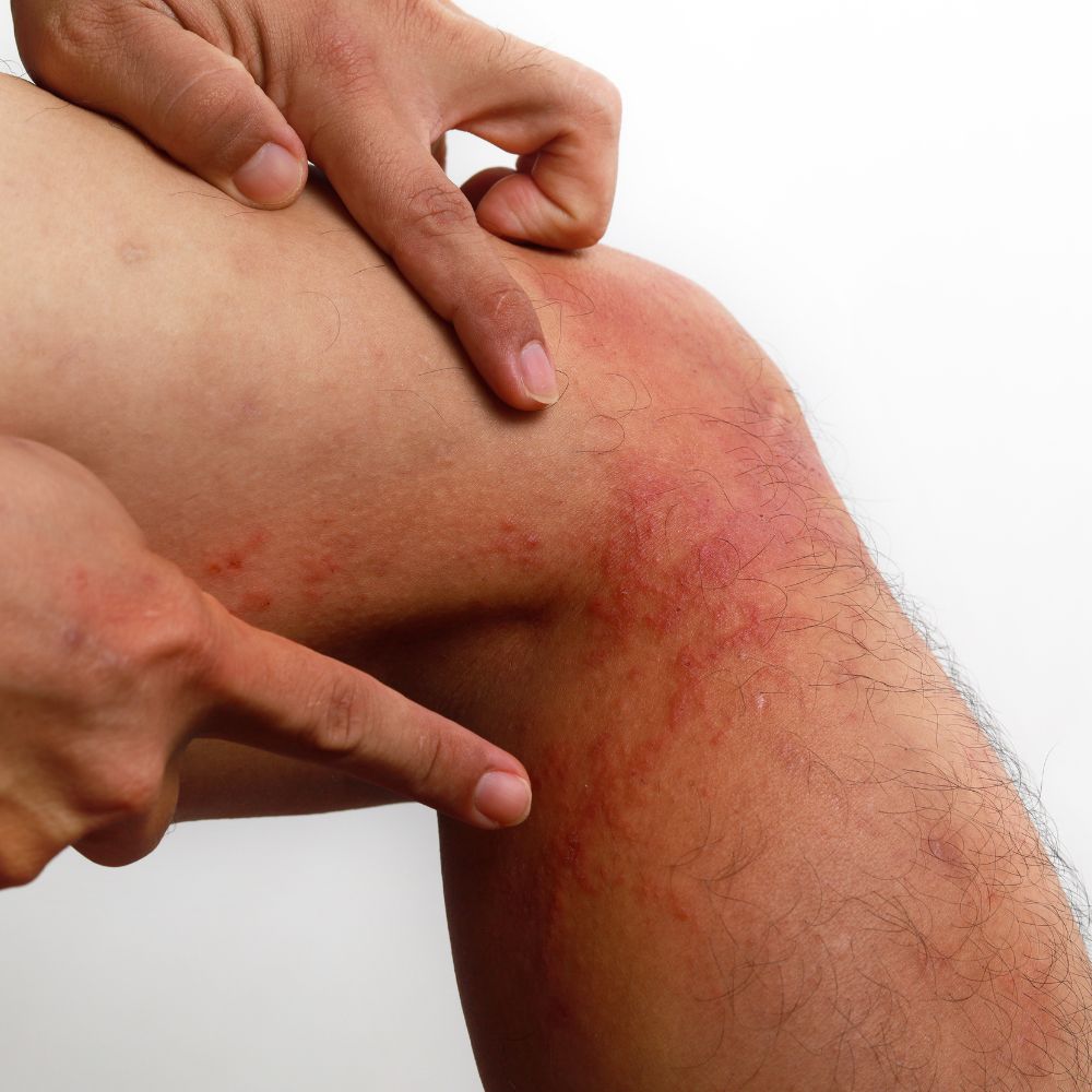 Eczema on the back of the knee