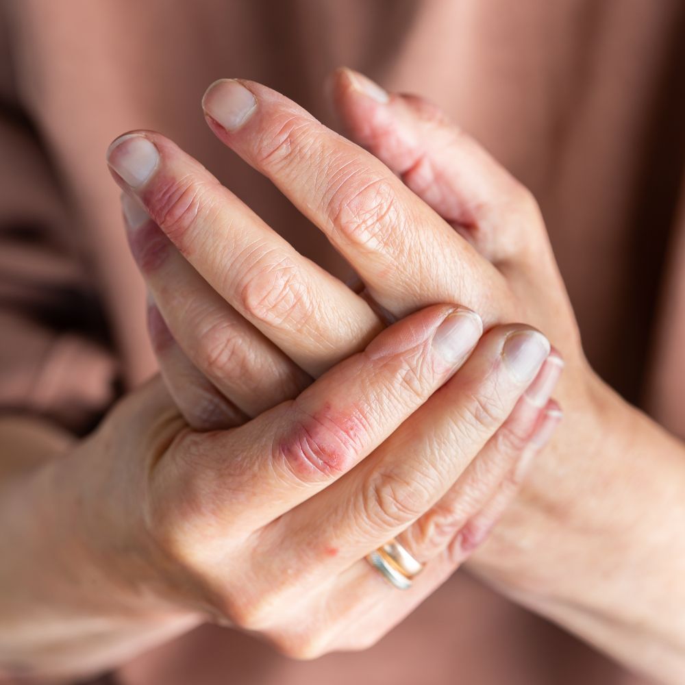 Person with eczema on their hands